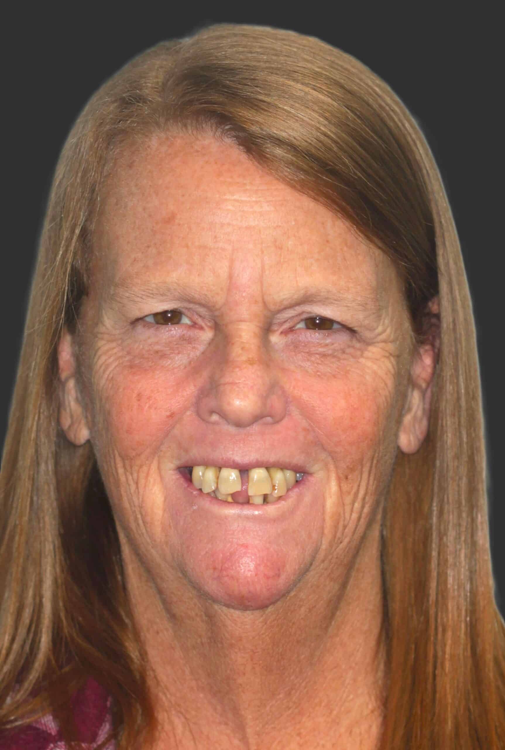 Close-up of smiling woman with long light brown hair, showing discolored, misaligned upper teeth.