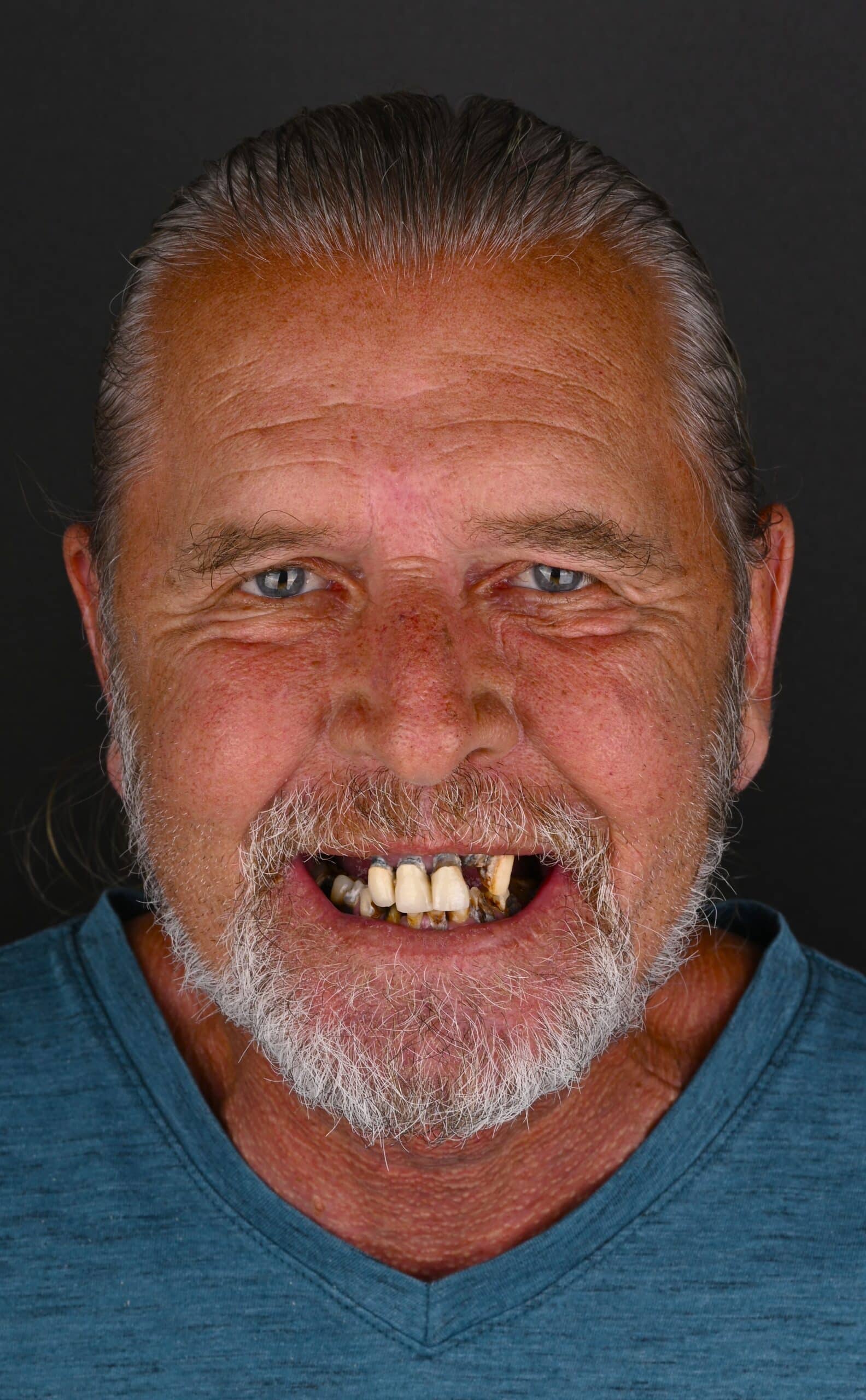 Close-up of an older man smiling, showing missing and yellowed teeth, with a gray beard and teal shirt against a dark background.